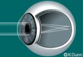Astigmatism Eye