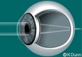 Farsighted Eye