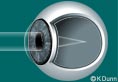 Nearsighted Eye