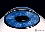 lasik, laser vision correction, Lasik, LASIK, vision correction, nearsighted, farsighted, astigmatism, near sighted, far sighted, short sighted, laser, eye, surgery, hyperopia, myopia, prk, PRK, ophthalmologists, ophthalmology, doctor, carrollton, georgia